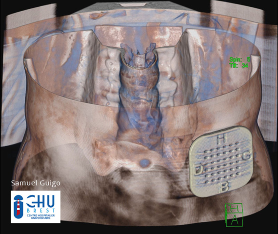 Radio 3D montrant la position exacte du guide en Nanovia PLA XRS sur le patient. Réalisé par Samuel Guigo - CHU BREST